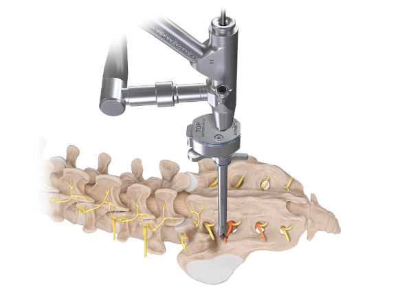 Arthrex - Endoscopic Approach to Sacroiliac Lateral Branch Nerve